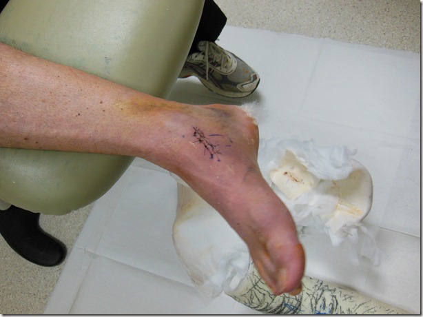 Bruised Foot